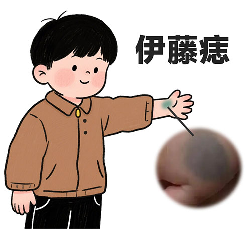 <strong>伊藤痣治疗后会复发吗？江苏的胎记医院哪家比较好？</strong>