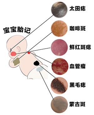 <strong>【健康胎记】婴儿胎记治疗后出现反黑正常吗？多久能好？</strong>