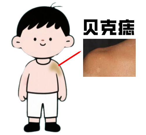 <strong>【每日案例】贝克痣激光能淡化吗？需要多少次治疗？</strong>