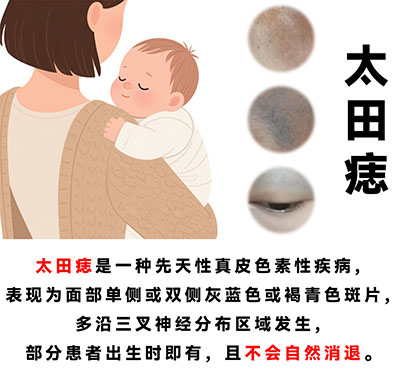 太田痣表面出现轻微凸起，是皮肤增厚还是病变？
