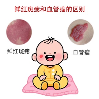 鲜红斑痣和血管瘤怎么区分？很多家长傻傻分不清楚！
