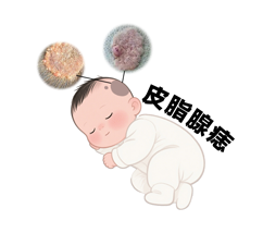 【误区纠正】皮脂腺痣不用治，长大了就好了？别信！