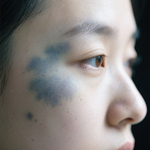 <strong>育儿须知 | 宝宝脸上有青灰色斑，可能是太田痣！</strong>