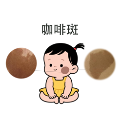 <strong>健康真相 | 咖啡斑会自己消失吗？多数家长想错了！</strong>