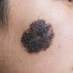 <strong>【专家答疑】黑毛痣突然增大、发痒、破溃，恶变征兆要认清！</strong>