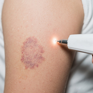 【康复指南】宝宝胎记治疗后，饮食上有忌口吗？