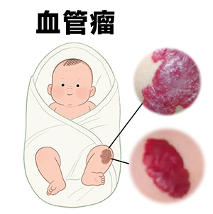 【康复护理】血管瘤治疗后怎么护理？促进恢复！