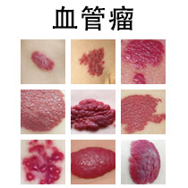 【健康科普】血管瘤有哪些类型？这些情况要警惕...