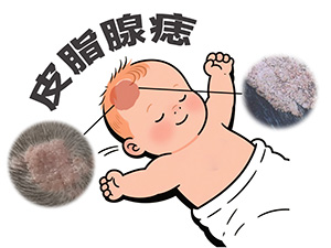 宝妈注意！宝宝头皮皮脂腺痣，洗头时别用力抓挠！