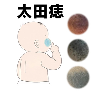 【太田痣黄金治疗年龄？】专家共识指向婴幼儿黄金期