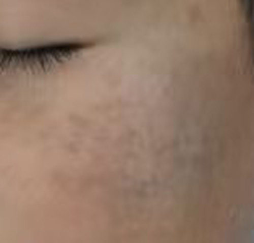 太田痣治疗过程痛不痛？南京胎记哪个医院好？