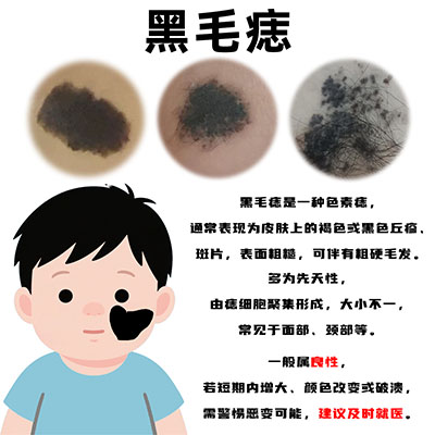南京胎记医生排名榜:黑毛痣的特征是什么？